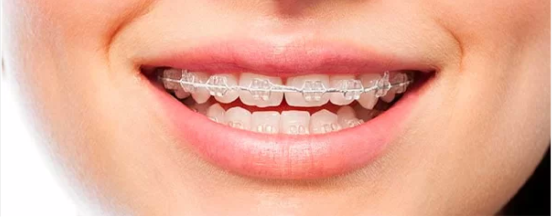 Ai intrebari in legatura cu bracketii aparatului dentar? Alege varianta potrivita pentru tine, dintre safir sau ceramica