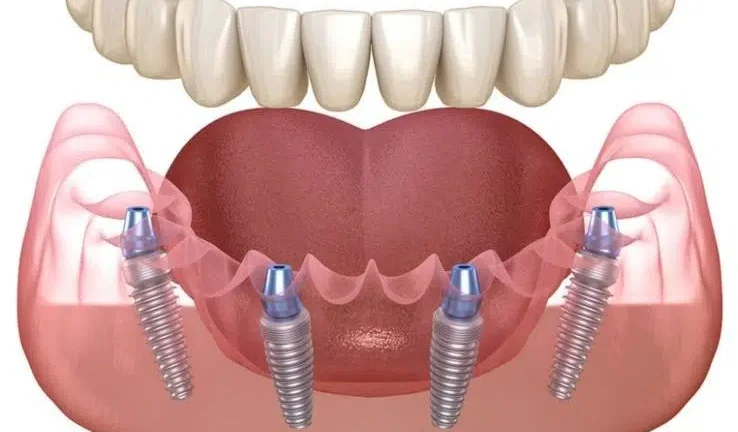 Alege implantul dentar în rate: Confort medical și financiar în același timp